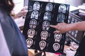 Lecanemab is designed to target and clear a protein called amyloid from patient’s brains (Photo: Adobe)