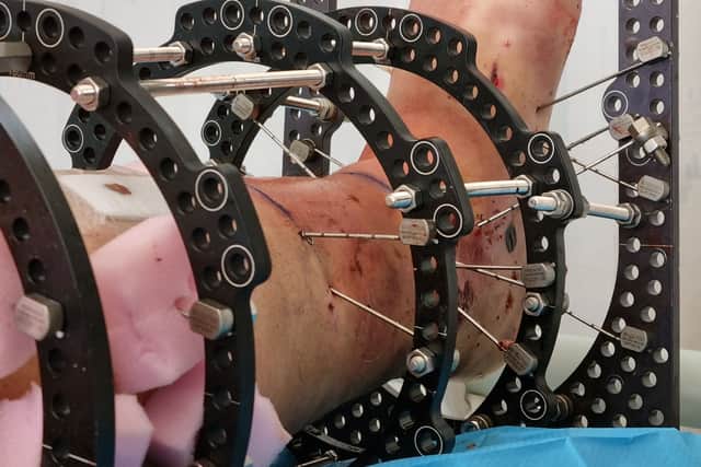 After a bike accident, Mark Kitchin was left with life-changing injuries.