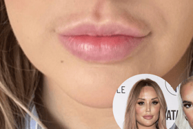 Lip filler