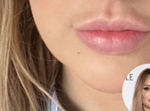 Lip filler