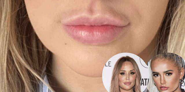 Lip filler