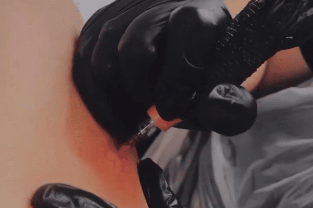 The areola tattooing is free of charge.