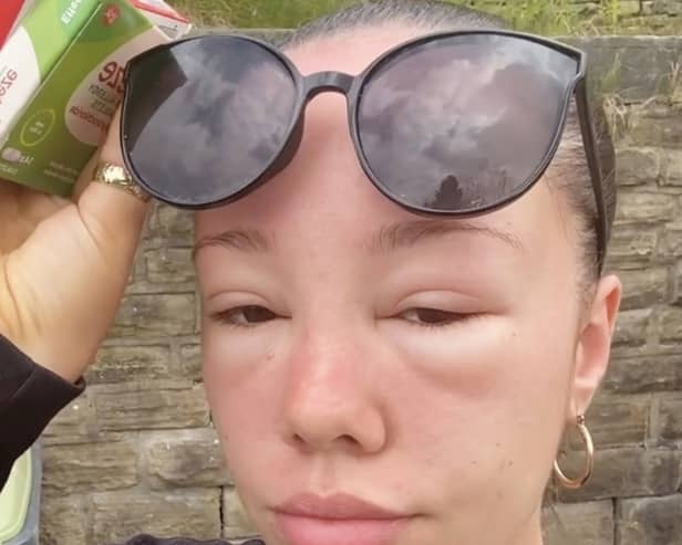 A Stockport woman’s eyes swelled over two days after she experienced sun poisoning.