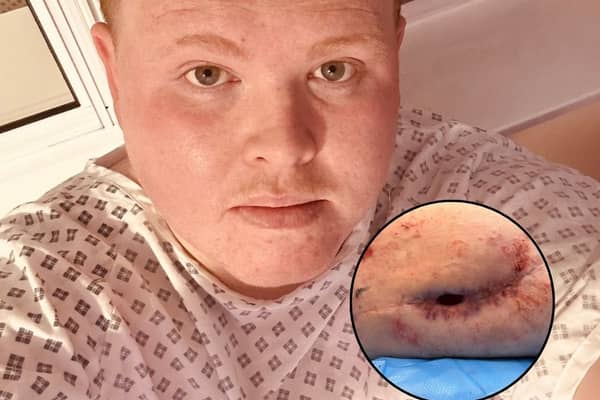 Tom Moss' hole in his leg | Tom Moss / SWNS
