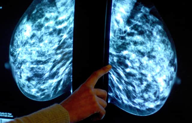 Generic stock picture of a mammogram showing a womans breast in order check for breast cancer at Derby City Hospital.